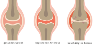 Arthrose, Arthrosetherapie, Therapie, Stammzellentherapie, Stoßwellentherapie, Gelenksabnützung, Gelenke - Dr. Michael Fink - Bregenz, Österreich, Schweiz, Deutschland